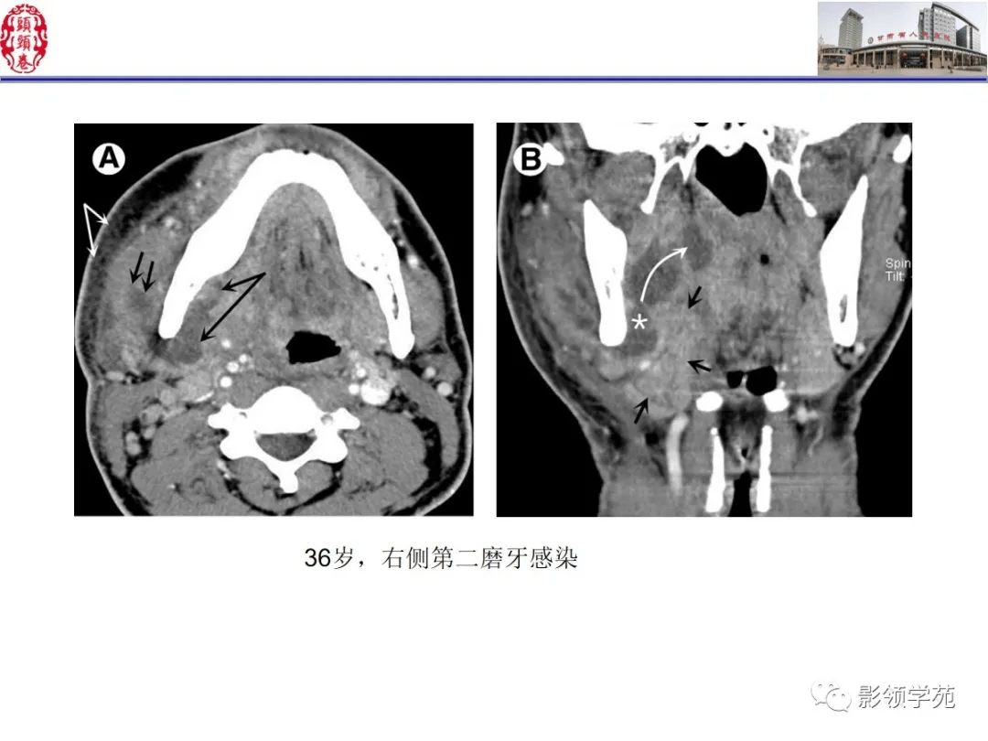 舌口底影像解剖及常见疾病诊断