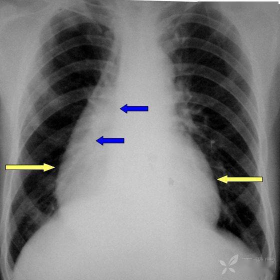 在心影外12陈旧性肺结核导致的胸廓塌陷?