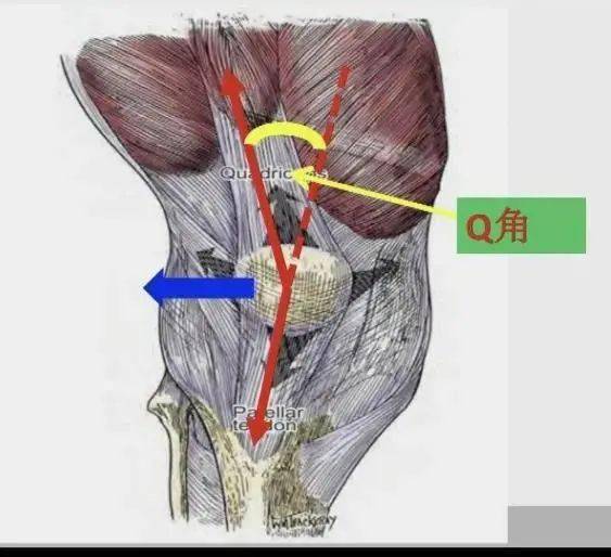 髌腱和股四头肌之间形成了一个夹角,称之为"q角",二者对髌骨牵拉的