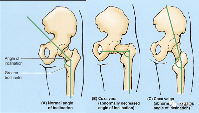 此外每个人在股骨颈(femoral neck)到大转子(femoral shaft)和股骨头