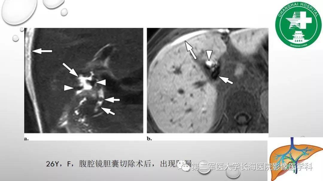 普美显丨肝胆特异性MRI对比剂-钆塞酸二钠Gd-EOB-DTPA-搜狐大视野-搜狐新闻