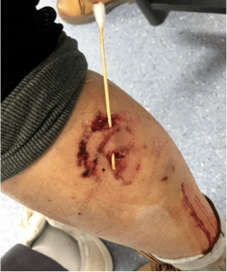 被大狗(后证实为"马犬")咬伤,其中张某被咬中左肘处,王某被咬中左小腿