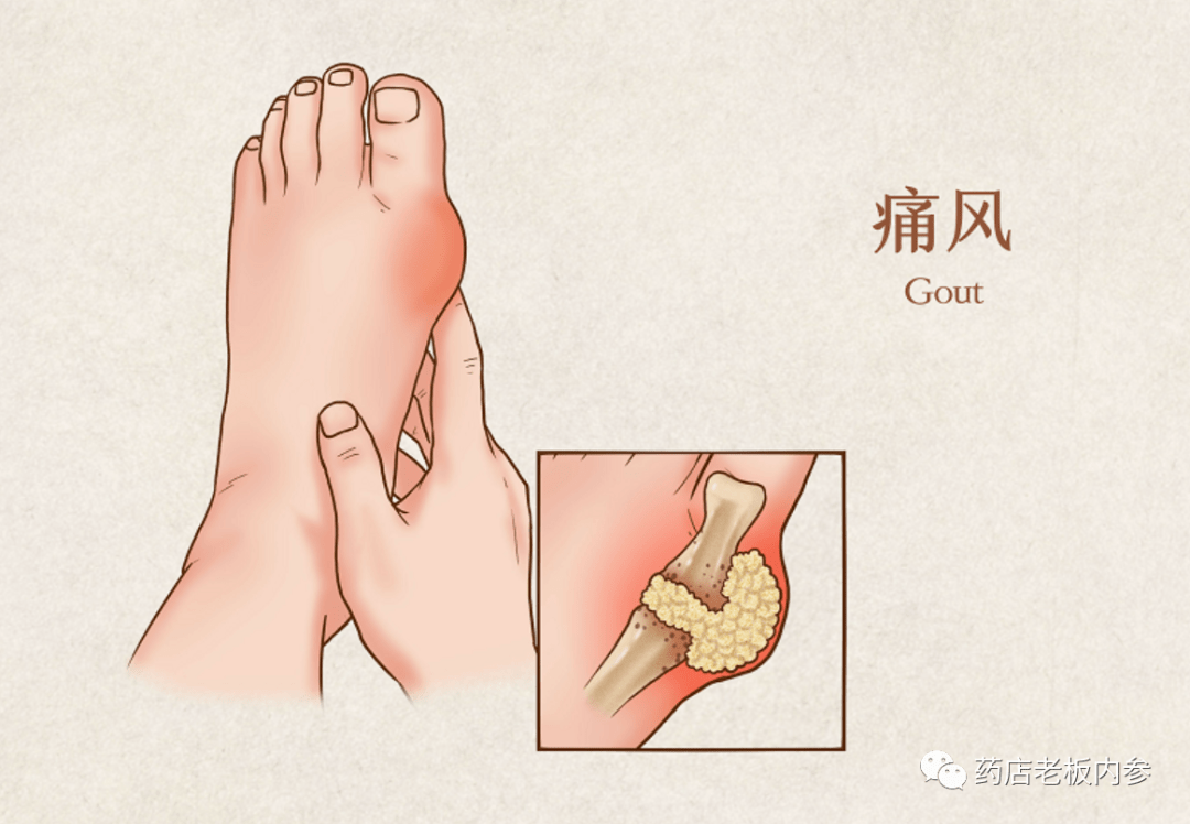 痛风急性发作秋水仙碱抗炎药糖皮质激素非布司他选谁最佳