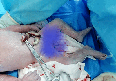 一例胎动减少的紧急剖宫产术
