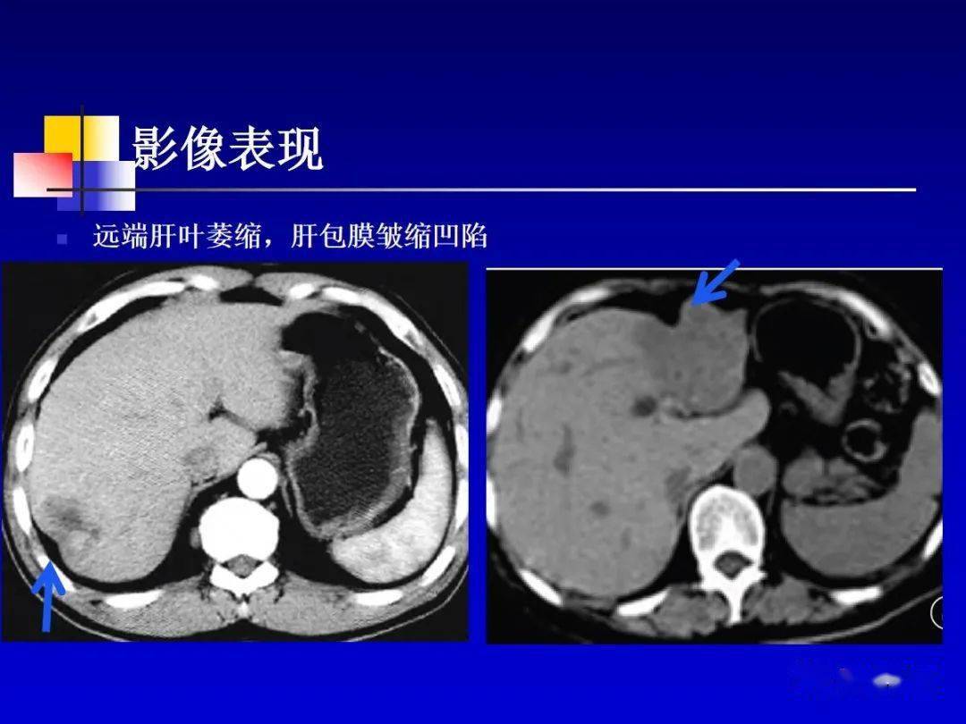 肝細胞肝癌hcc與膽管細胞癌icc影像診斷要點