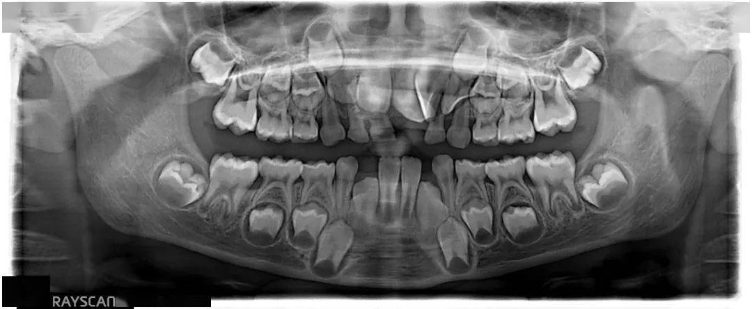 罗xx 20210118 多生牙cbct 134xxxx3381