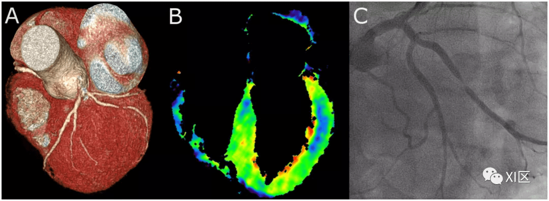 动态心肌灌注ct成像原理诊断性能与临床价值