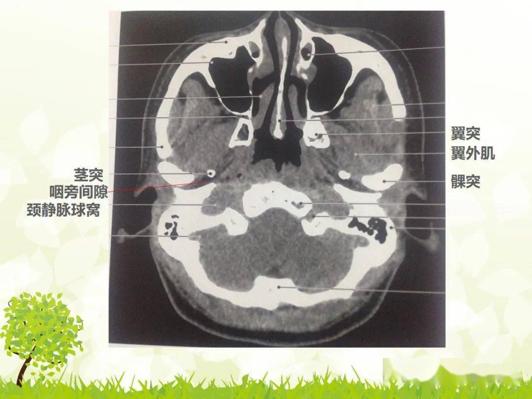 咽旁间隙解剖及常见病变影像表现