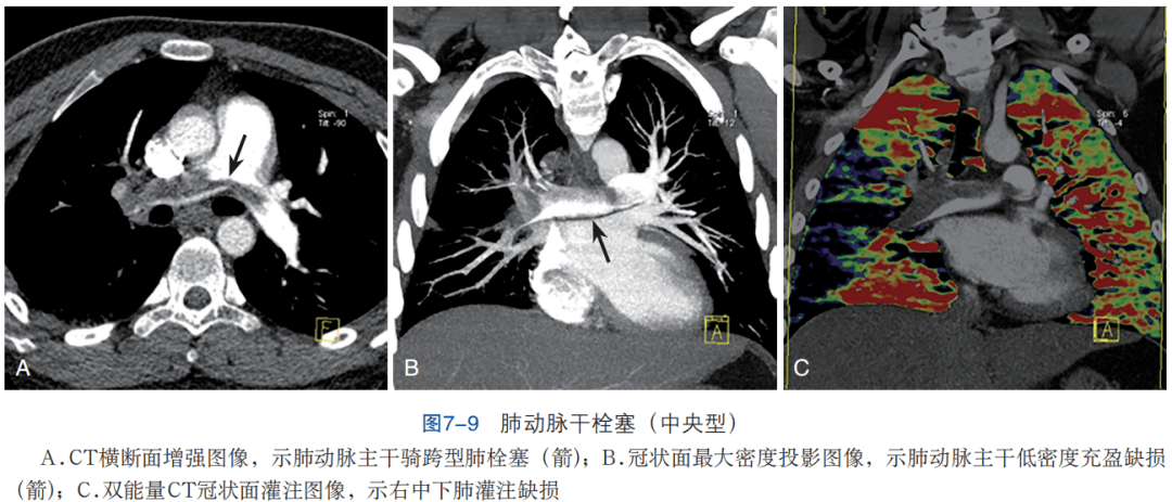 乾貨秒懂ct血管成像檢查和診斷要點急性肺動脈栓塞