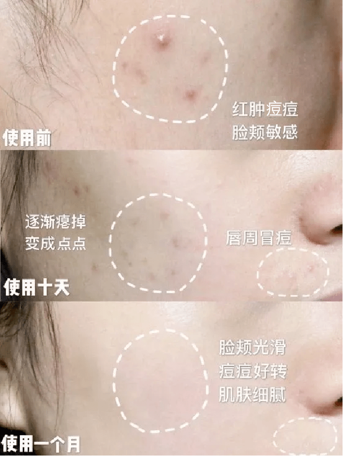 脸上的痘坑怎么弄 dfabf7e1178649259c9935e7c18de4c8.png