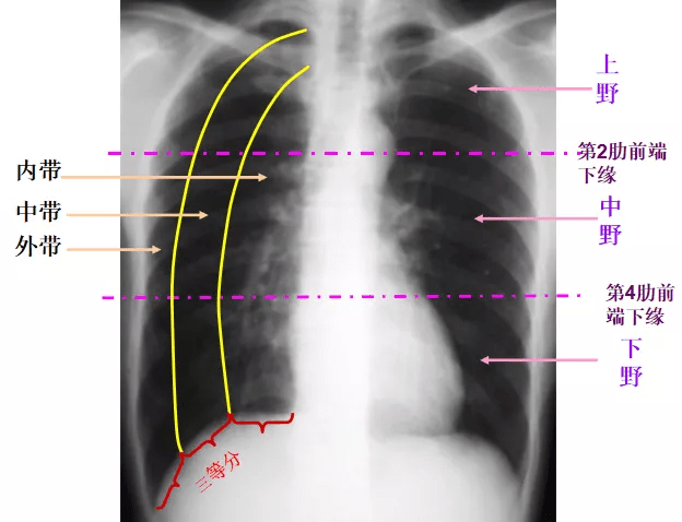 图7肺纹理的形成:肺动脉,肺静脉,支气管,淋巴管,少量间质组织
