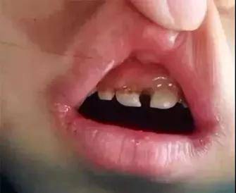 梦见两颗上门牙掉了，掉得不干净，上面还有一半长在嘴里，吐了点点血——梦境解析与心理暗示