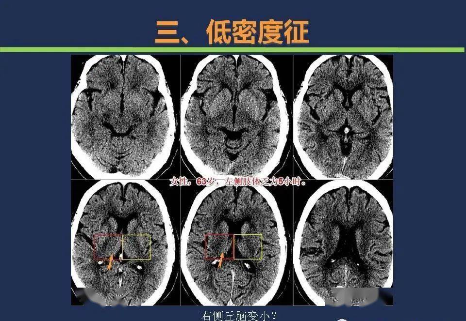 脑梗塞ct图片解读图片