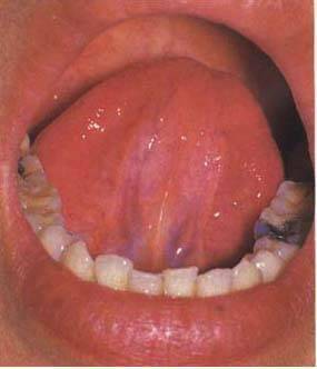 61张高清舌诊图谱图文对照珍藏版