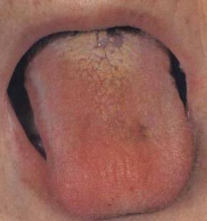 61张高清舌诊图谱图文对照珍藏版