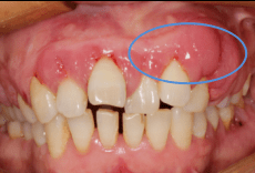 牙龈增生图片 症状图片