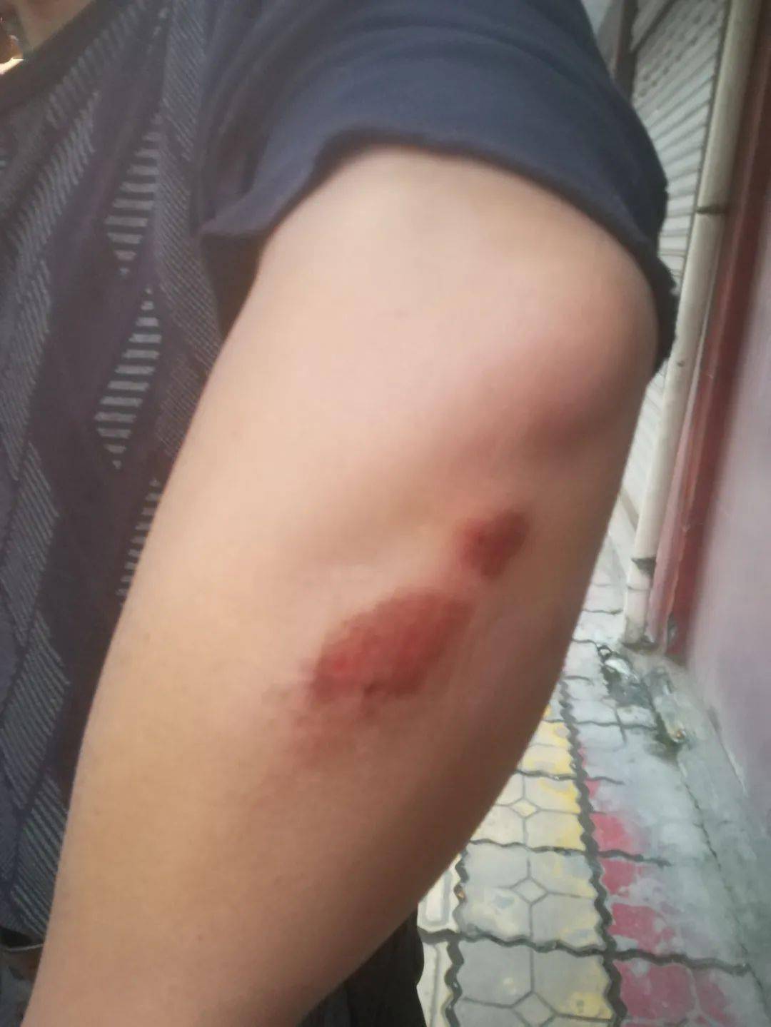 由于救人心切,男子的手臂被擦伤