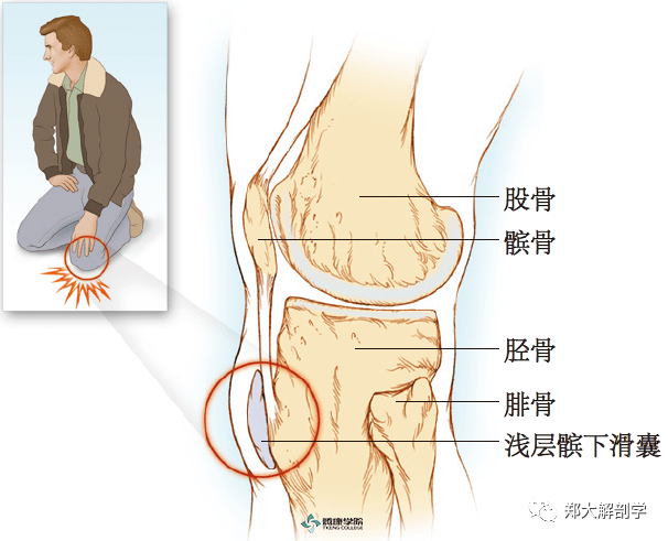 膝盖滑囊位置图片图片