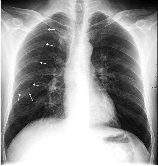 肺部正常ct阅片入门图片