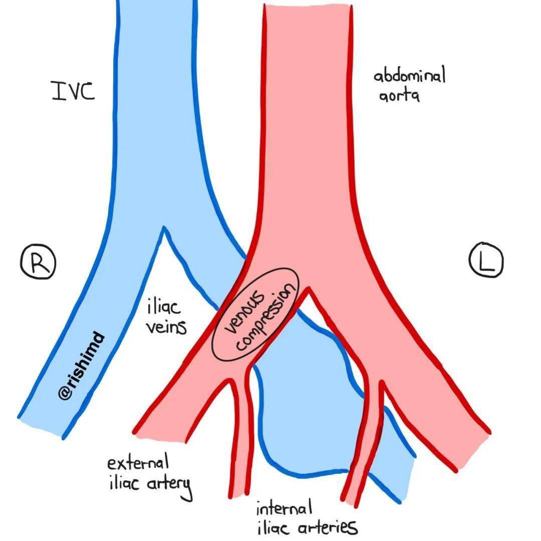 髂静脉血管解剖图图片