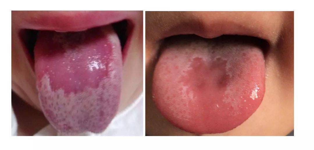 怎么看小孩舌苔厚不厚 f73027052816424e97905c62d1a0d250.jpeg