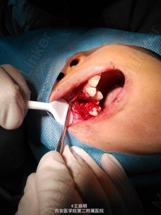 在治疗左上前牙牙髓炎的同时意外的发现