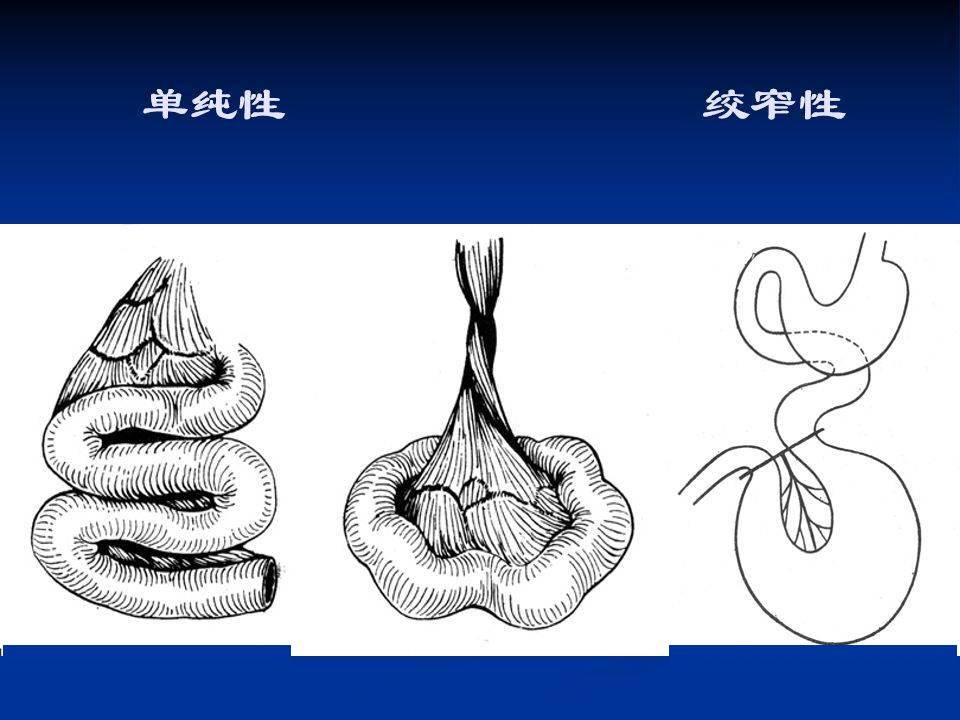 鱼骨刺征肠梗阻图片图片