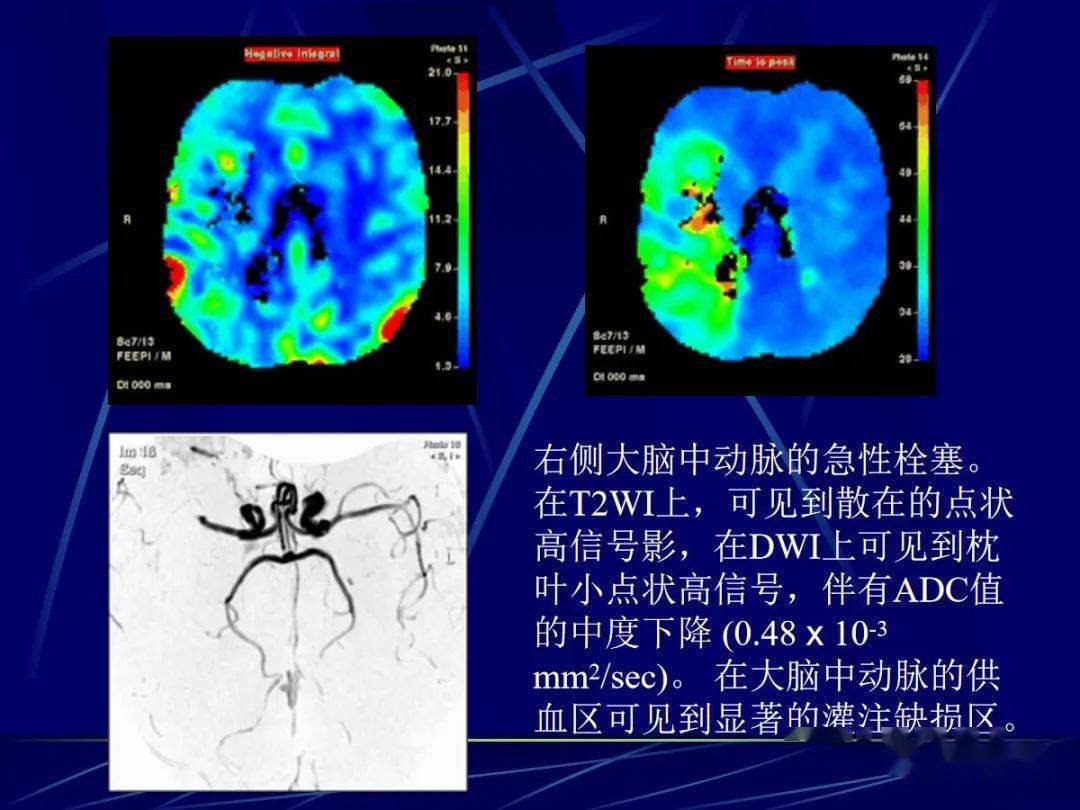 頭顱mri中不同序列dwi和adc的區別