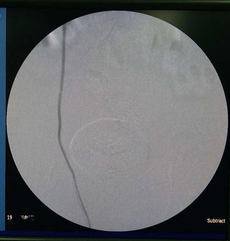 右侧精索静脉曲张术前造影