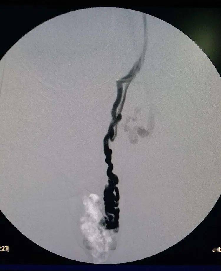 精索静脉曲张泡沫硬化剂栓塞术及术后随访情况