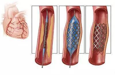 实拍22组图带你真实了解冠脉支架介入术