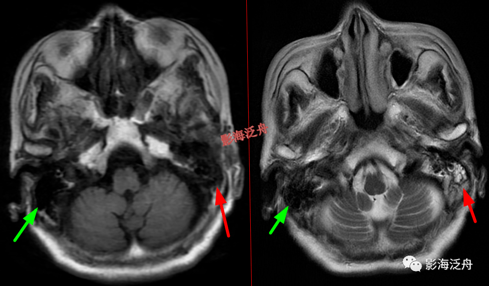 超级干货颅脑mr中易漏诊点全面总结