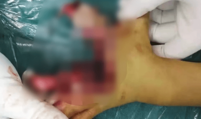 长沙8岁男童捡烟花燃放手被炸烂，骨头外露，画面令人心痛！