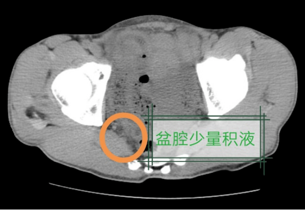 需立即住院治疗不排除少量出血黄先生下腹,盆腔少量积液医生通过急诊