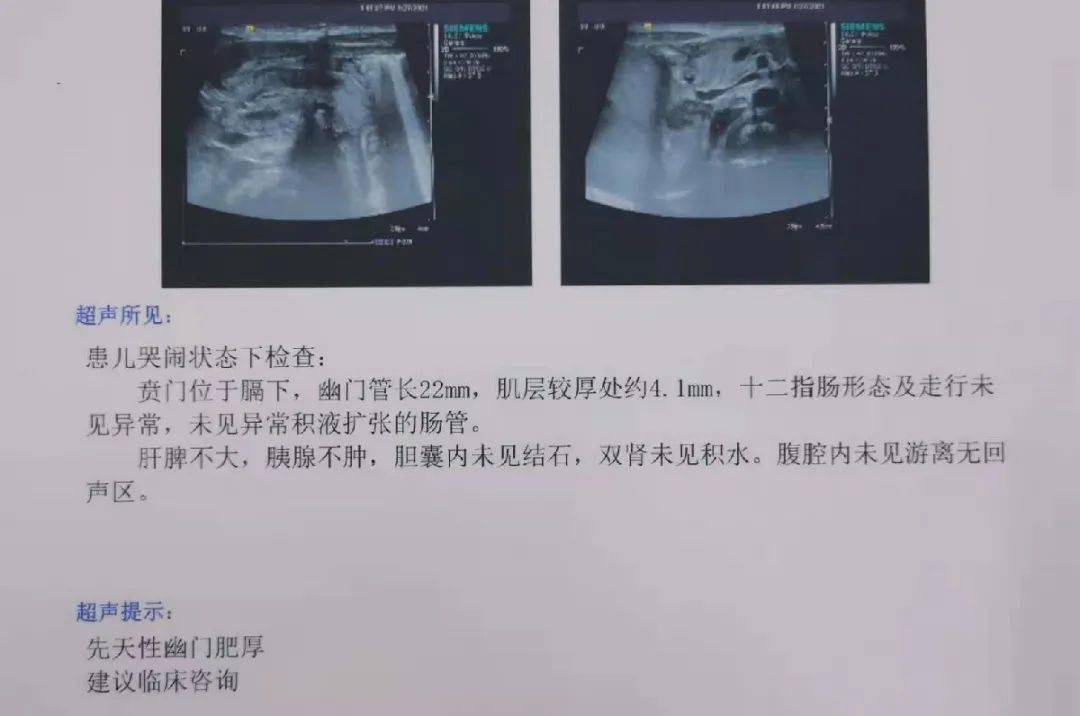 儿外科科普时间 | 不满月的宝宝严重呕吐,要警惕先天性幽门狭窄_手机