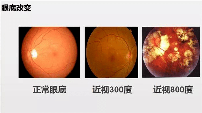 什么是青光眼什么是白内障 b83dc6d8dabd44858946c1d16af61828.png