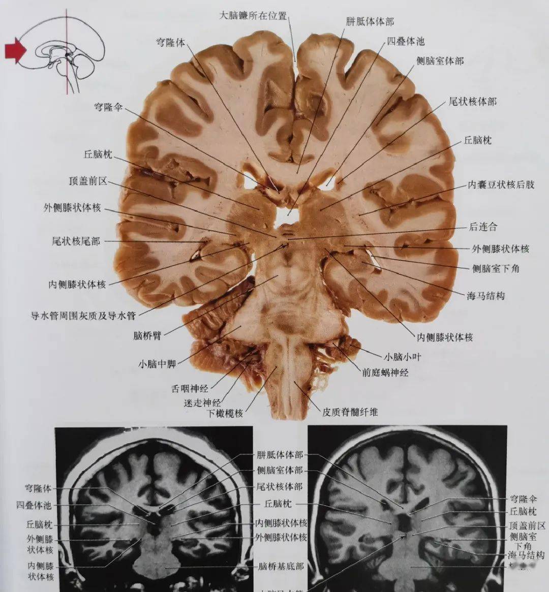 小脑中脚断层解剖图片
