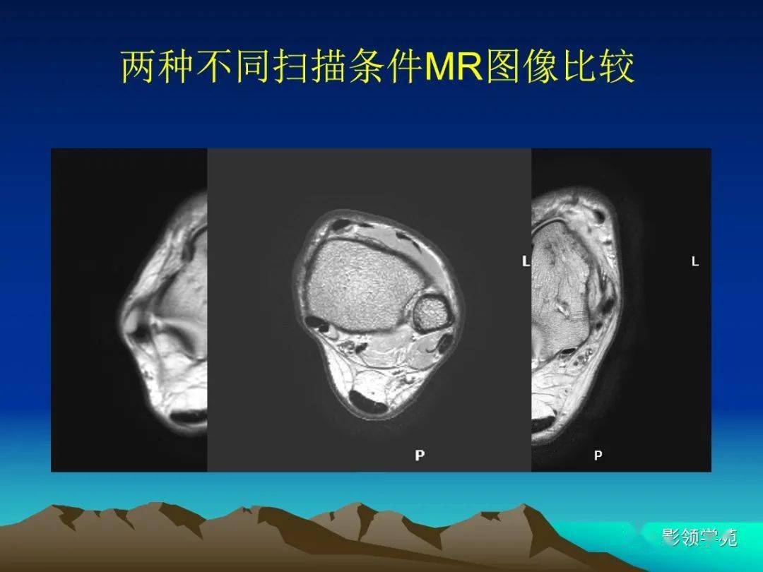 踝關節韌帶或其他軟組織損傷可能會導致較嚴重的創傷性骨關節炎,骨質