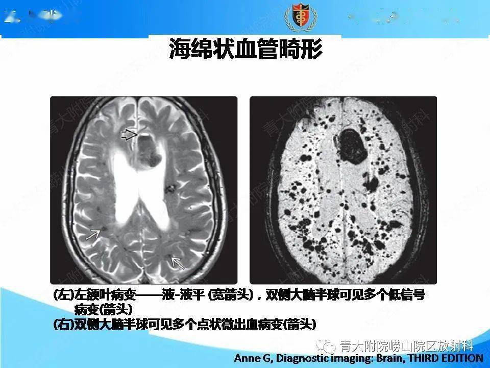 【影像】淀粉样脑血管病的影像诊断与鉴别诊断
