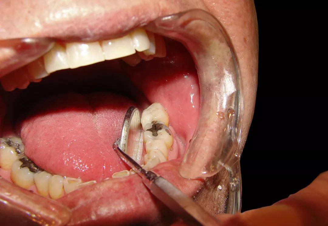 急性化脓性牙髓炎图片