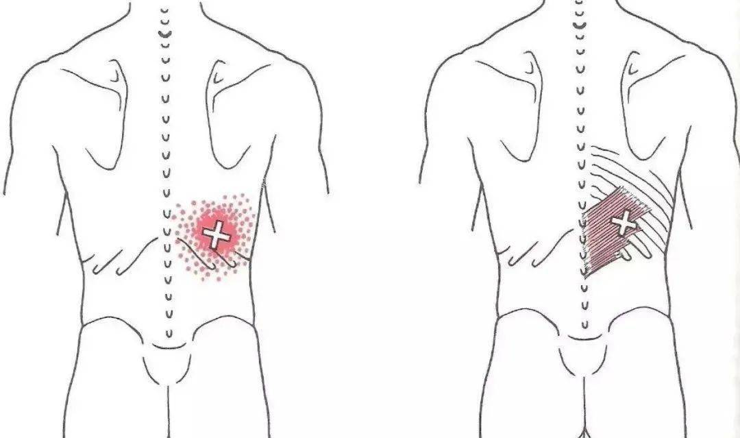 腰肌筋膜触痛点主要表现为腰背部弥漫性钝痛,尤以两侧腰肌及髂嵴上方