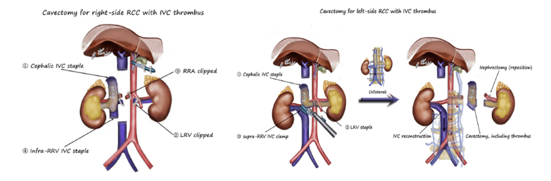 董培教授2020年度肾癌临床研究的中国智造
