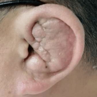 耳朵又红又肿碰都不敢碰也可能是风湿病