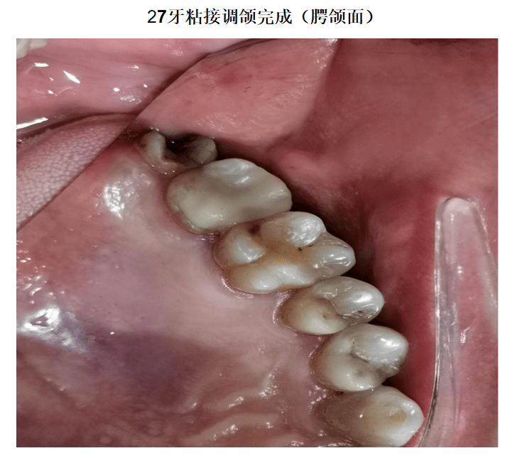 上颌第二磨牙颌面图图片