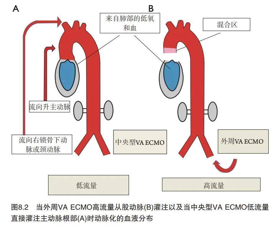 体外生命支持与正常循环系统之间的相互作用ecmo成人的体外生命支持