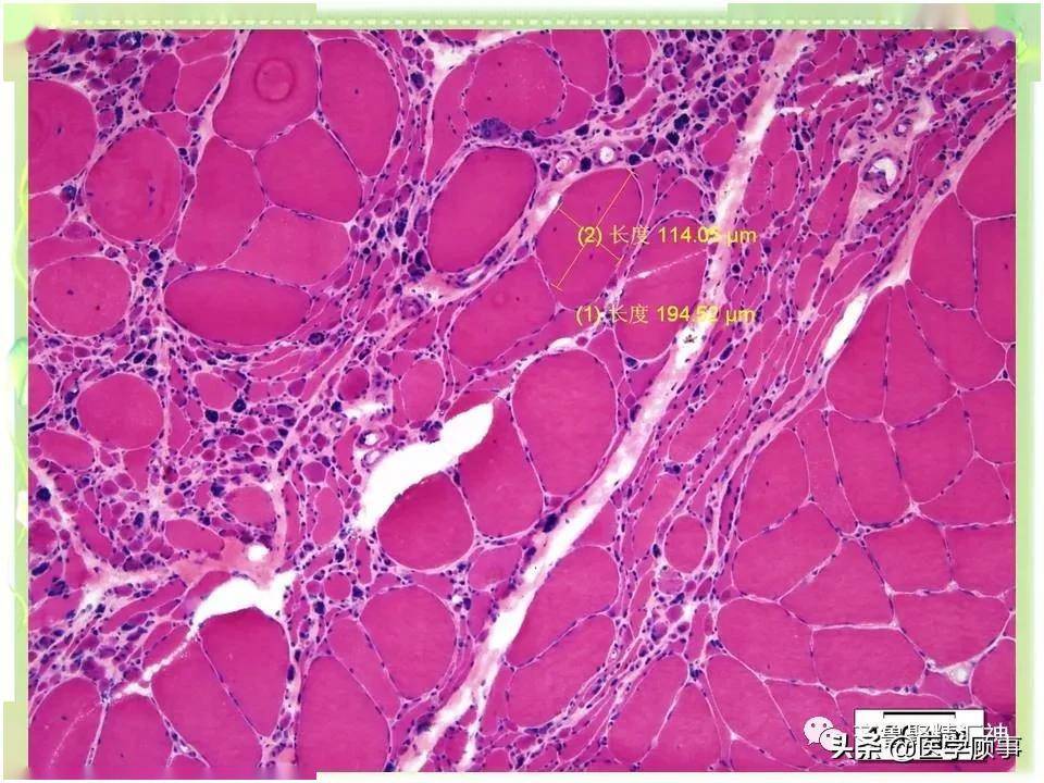 特殊运动神经元病肯尼迪病