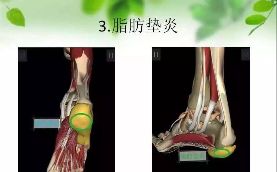 足跟痛及其相关解剖