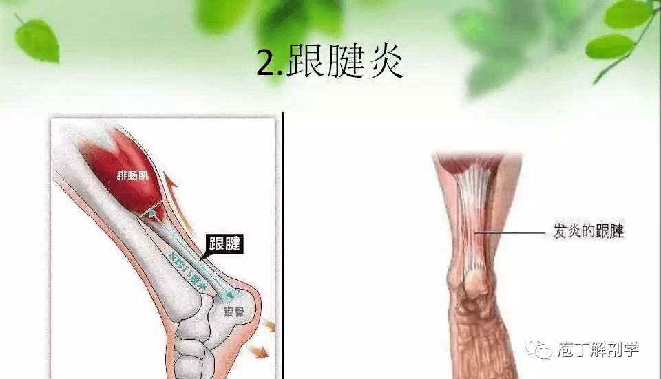 首先看一下跟后滑囊炎,足后呢共有两个滑囊,一个位于皮肤与跟腱之间