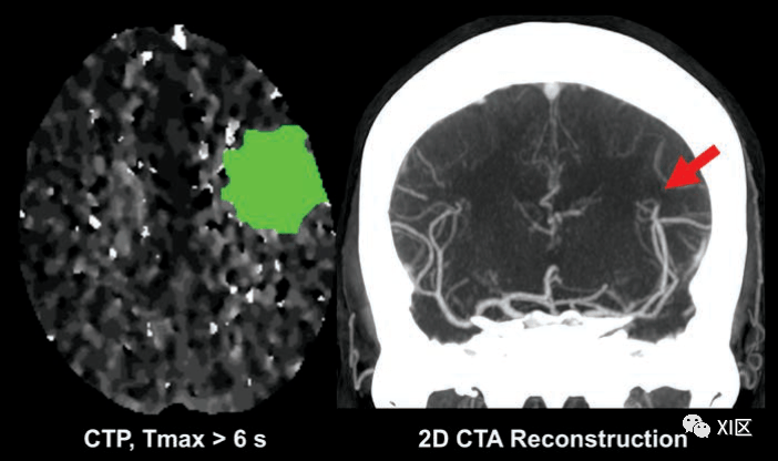 所有疑似脑卒中患者是否都应进行ct灌注和cta检查