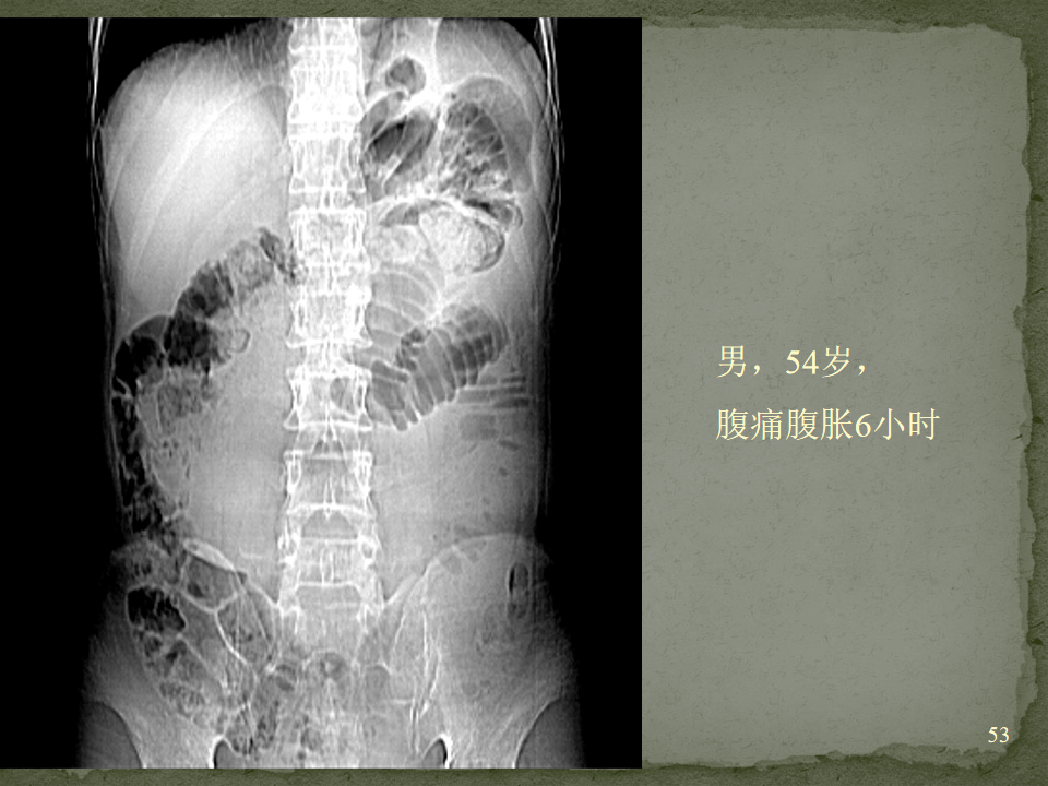 肠梗阻ct表现图片
